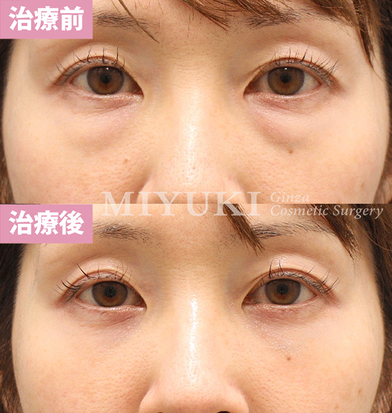 モニター症例№427（35歳 女性）脱脂コンデンスリポ