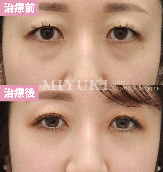 モニター症例№428（27歳 女性）脱脂コンデンスリポ