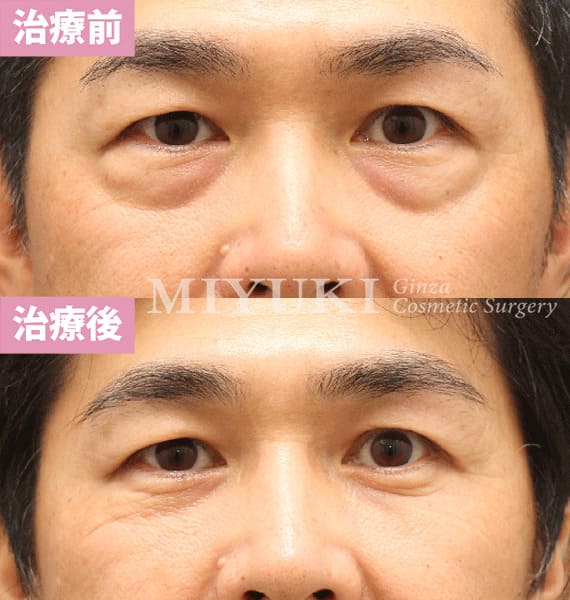 モニター症例№431（49歳 男性）脱脂コンデンスリポ