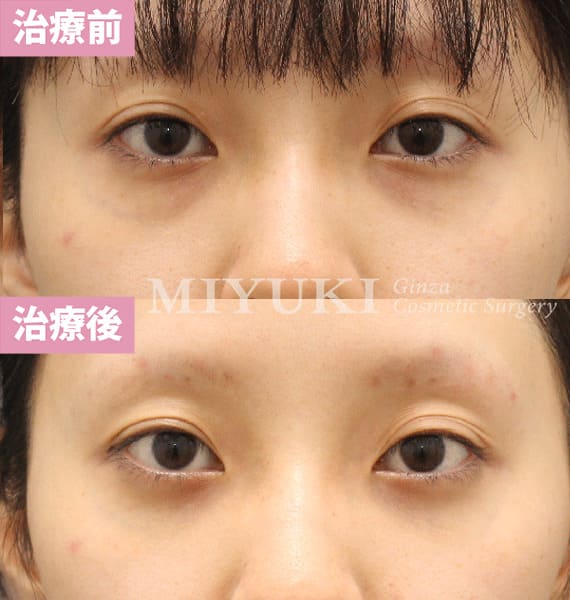 モニター症例№432（25歳 女性）脱脂コンデンスリポ