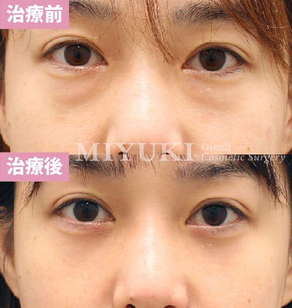 モニター症例№433（37歳 女性）脱脂コンデンスリポ