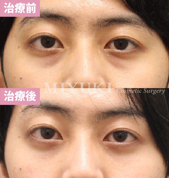 モニター症例№434（31歳 男性）脱脂コンデンスリポ