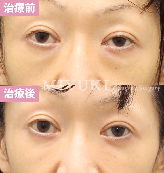 モニター症例№435（55歳 女性）脱脂コンデンスリポ