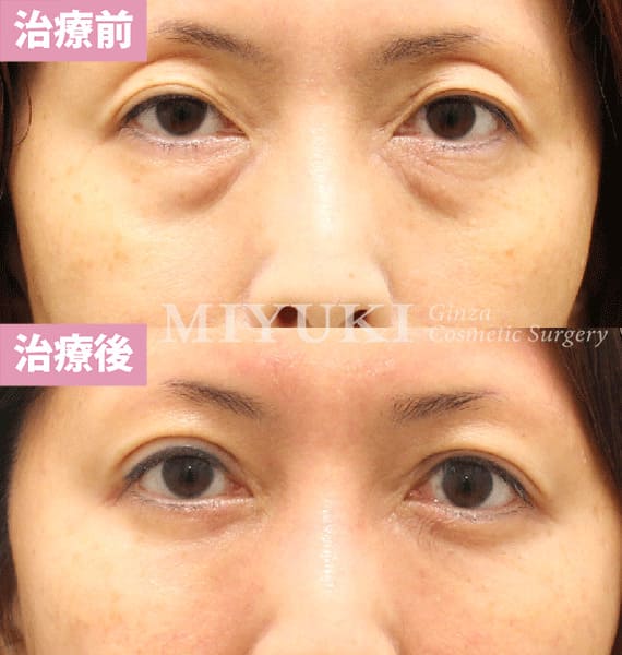 モニター症例№436（48歳 女性）脱脂コンデンスリポ