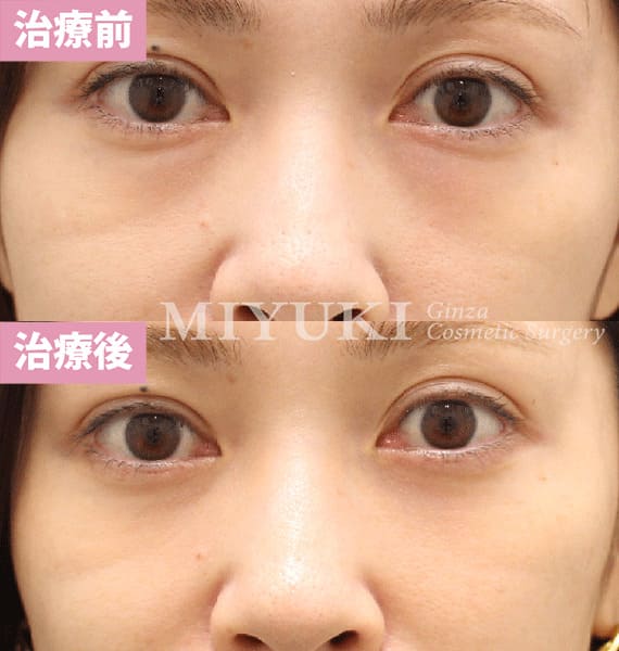 モニター症例№438（36歳 女性）脱脂コンデンスリポ