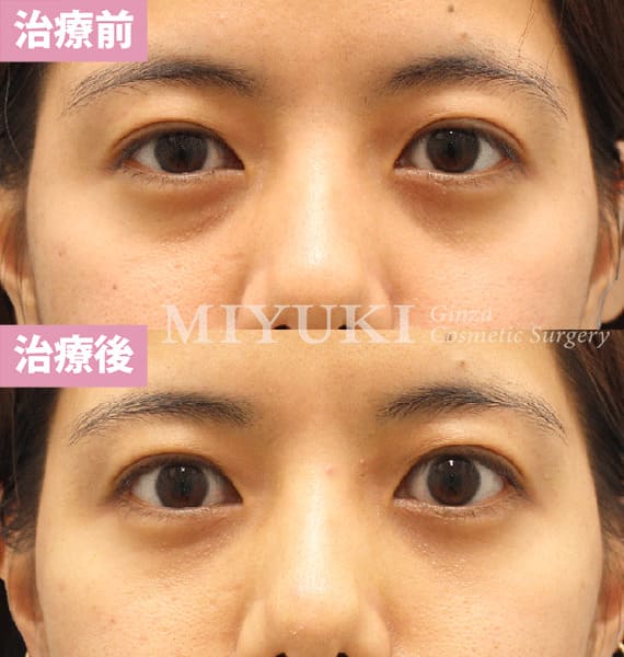 モニター症例№440（26歳 女性）脱脂コンデンスリポ