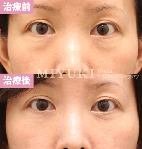 モニター症例№441（41歳 女性）脱脂コンデンスリポ