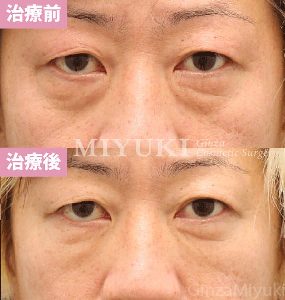 モニター症例№443（48歳 男性）脱脂コンデンスリポ