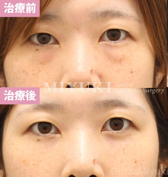 モニター症例№444（30歳 女性）脱脂コンデンスリポ