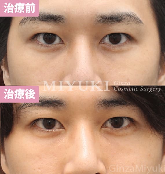 モニター症例№445（27歳 男性）脱脂コンデンスリポ