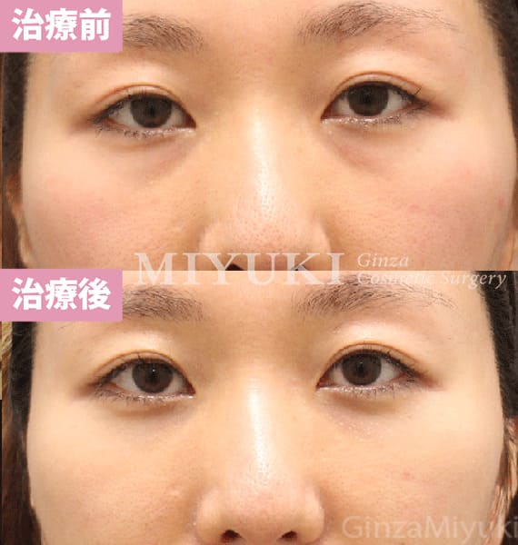 モニター症例№446（29歳 女性）脱脂コンデンスリポ