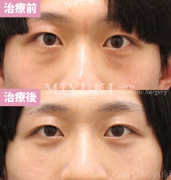 モニター症例№447（26歳 男性）脱脂コンデンスリポ