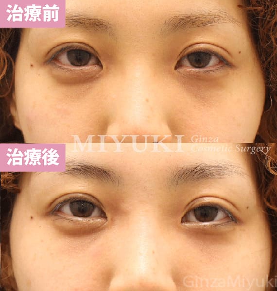 モニター症例№448（33歳 女性）脱脂コンデンスリポ