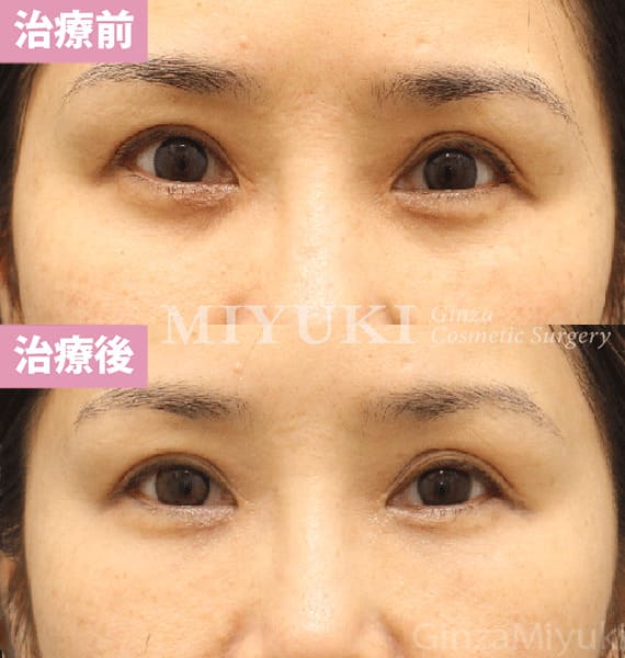 モニター症例№449（46歳 女性）コンデンスリポ