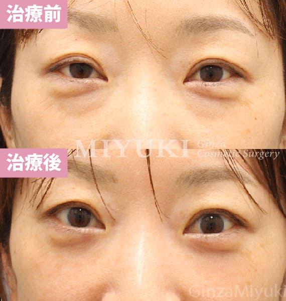 モニター症例№451（44歳 女性）脱脂コンデンスリポ