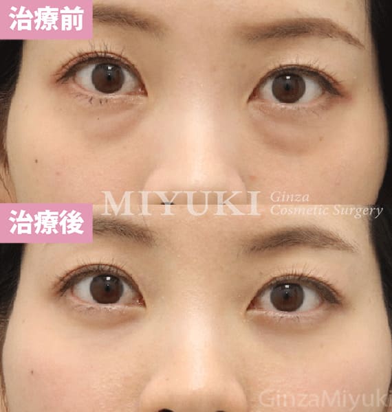 モニター症例№452（31歳 女性）脱脂コンデンスリポ