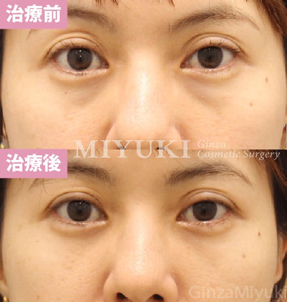 モニター症例№453（41歳 女性）脱脂コンデンスリポ