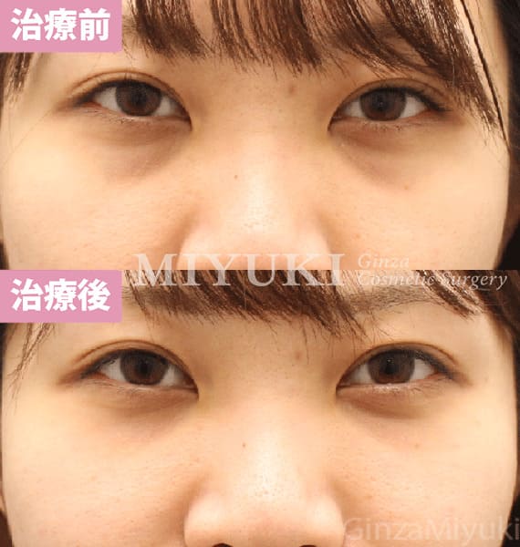 モニター症例№454（31歳 女性）脱脂コンデンスリポ