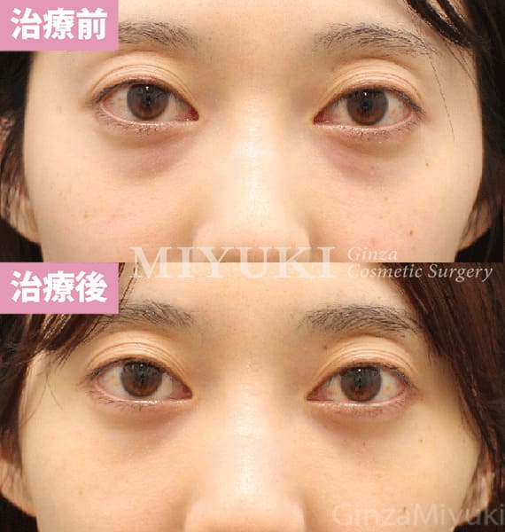 モニター症例№456（32歳 女性）脱脂コンデンスリポ