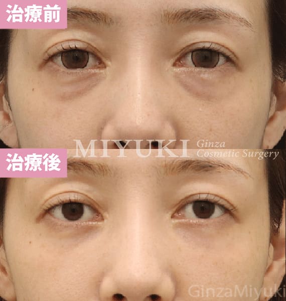 モニター症例№457（31歳 女性）脱脂コンデンスリポ