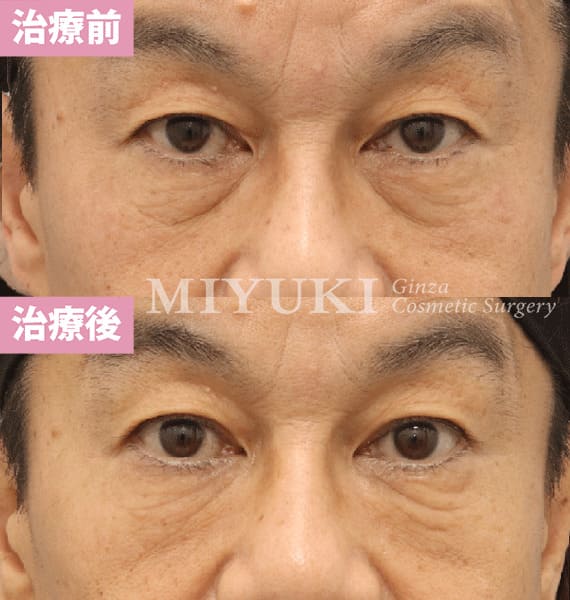 モニター症例№458（54歳 女性）脱脂コンデンスリポ