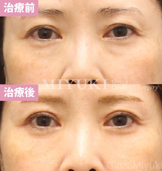 モニター症例№459（59歳 女性）脱脂コンデンスリポ