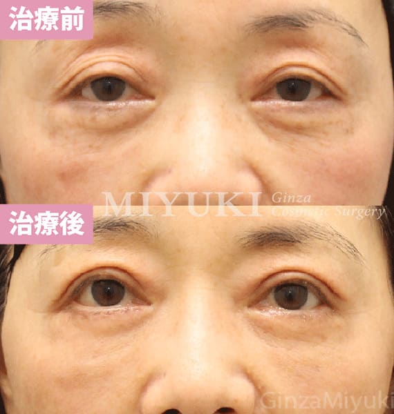 モニター症例№461（65歳 女性）ハムラ