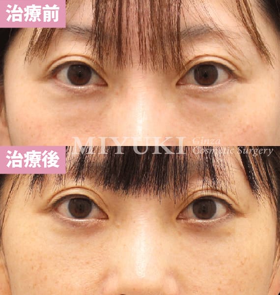 モニター症例№463（41歳 女性）脱脂コンデンスリポ