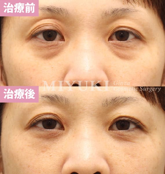 モニター症例№464（46歳 女性）脱脂コンデンスリポ