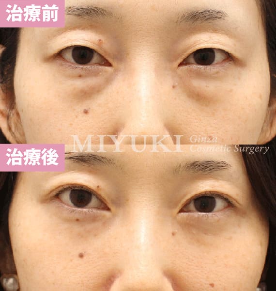 モニター症例№466（41歳 女性）脱脂コンデンスリポ