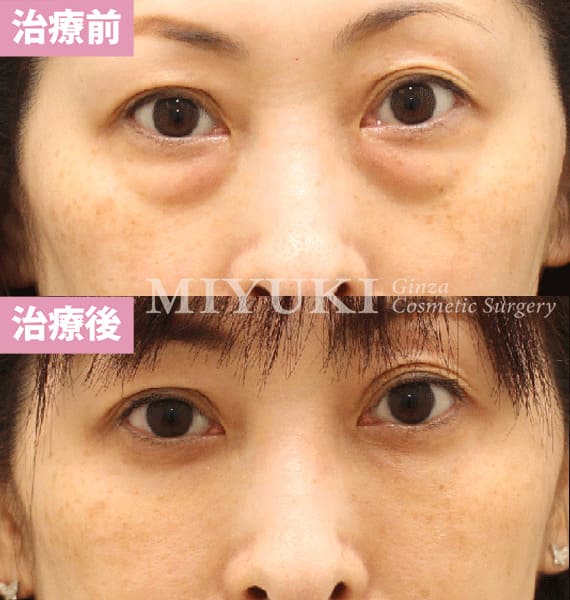 モニター症例№467（46歳 女性）ハムラ法