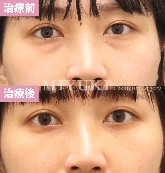 モニター症例№468（28歳 女性）脱脂コンデンスリポ