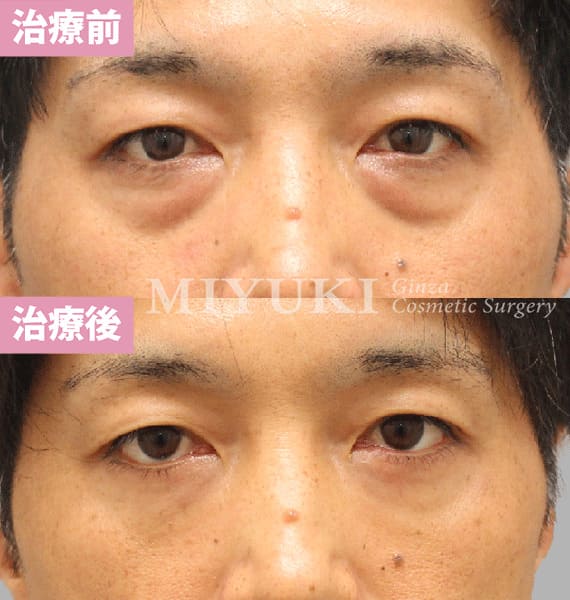 モニター症例№469（44歳 男性）ハムラ法