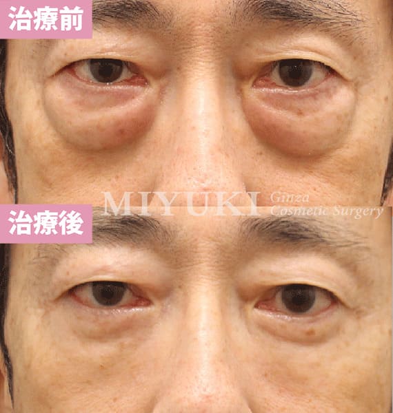 モニター症例№470（61歳 男性）ハムラ法