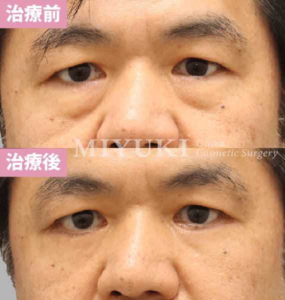 モニター症例№471（56歳 男性）ハムラ法