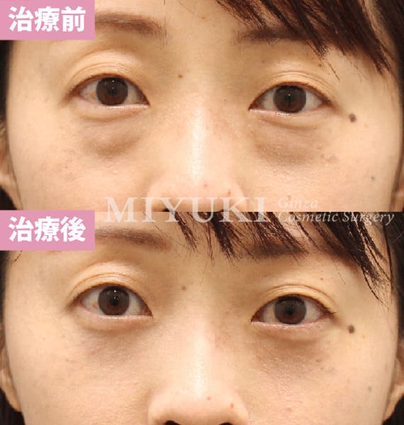 モニター症例№472（36歳 女性）脱脂コンデンスリポ