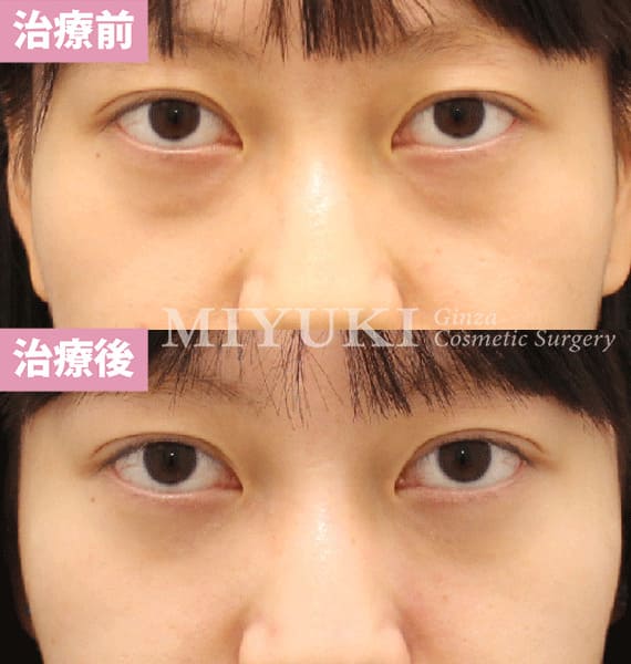 モニター症例№473（23歳 女性）ハムラ法