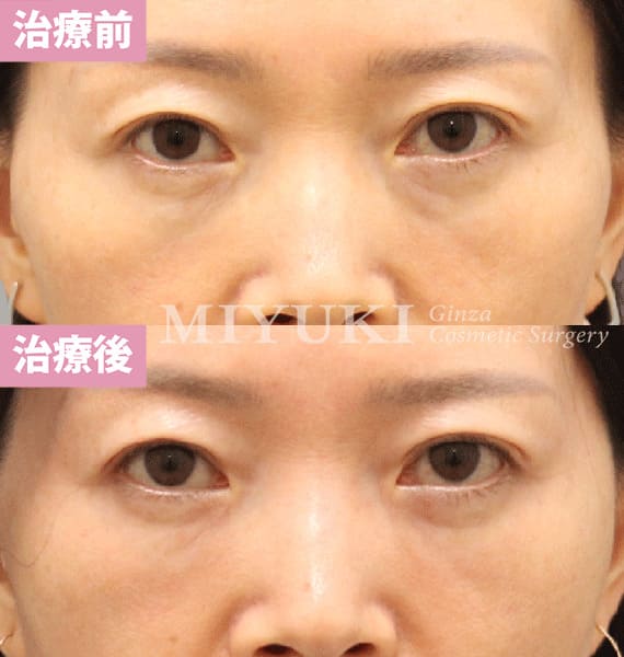 モニター症例№474（48歳 女性）脱脂コンデンスリポ