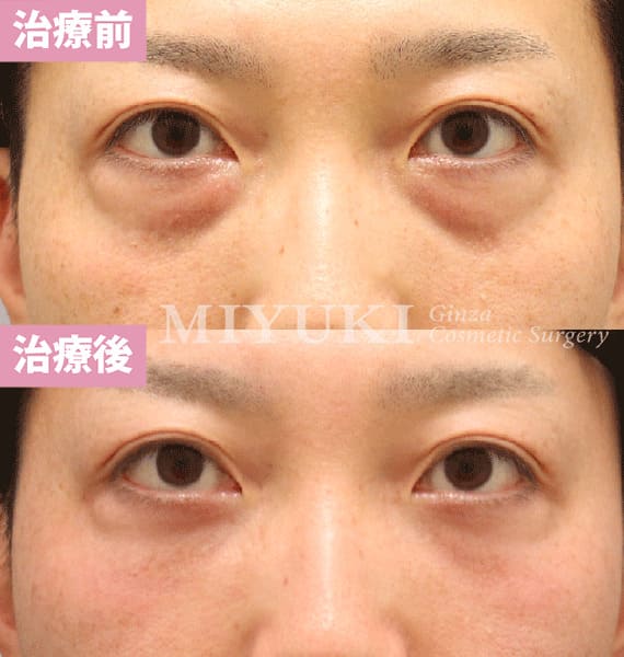 モニター症例№475（35歳 女性）脱脂コンデンスリポ