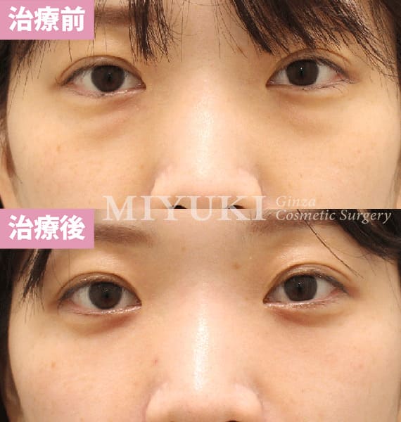 モニター症例№476（29歳 女性）脱脂コンデンスリポ