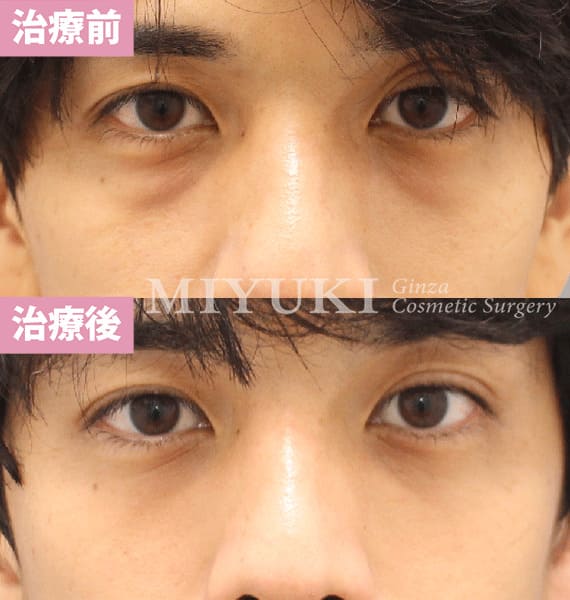 モニター症例№477（29歳 男性）脱脂コンデンスリポ