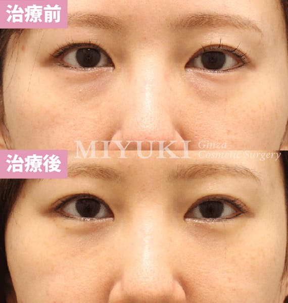 モニター症例№478（31歳 女性）脱脂コンデンスリポ