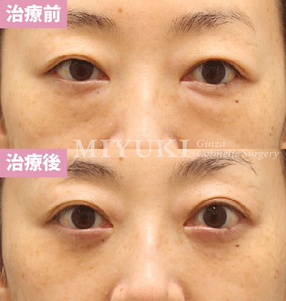 モニター症例№479（44歳 女性）脱脂コンデンスリポ