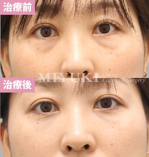 モニター症例№480（40歳 女性）脱脂コンデンスリポ