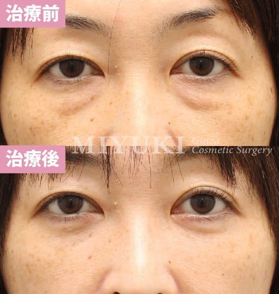 モニター症例№481（45歳 女性）ハムラ法