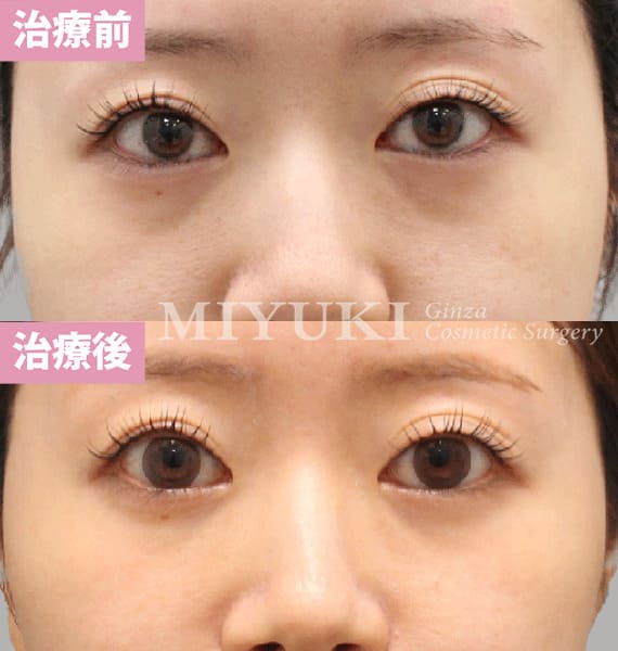 モニター症例№482（27歳 女性）脱脂コンデンスリポ