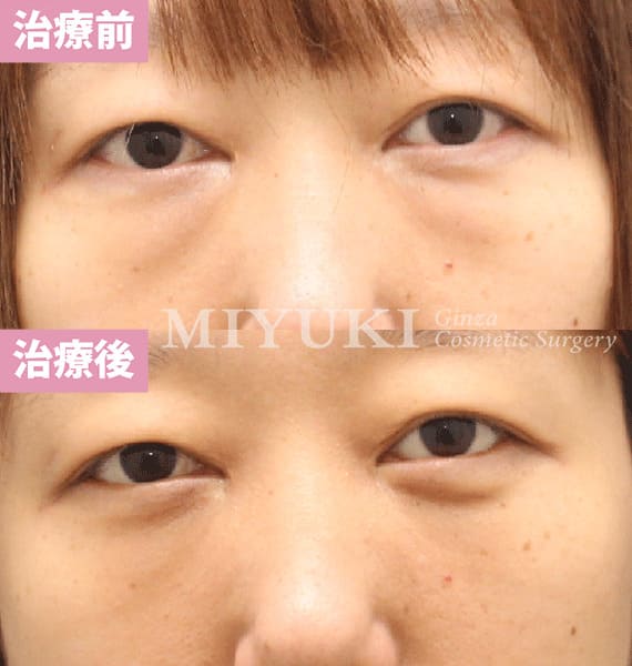 モニター症例№483（31歳 女性）ハムラ法