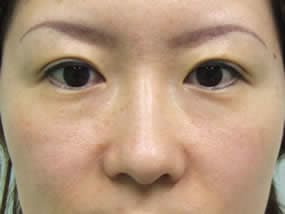 目の下のクマ・タルミ症例手術前（メイクあり）