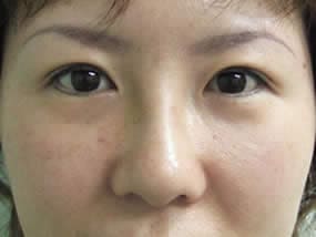 目の下のクマ・タルミ症例手術直後（メイクなし）