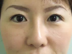 目の下のクマ・タルミ症例手術１週間後（メイクあり）